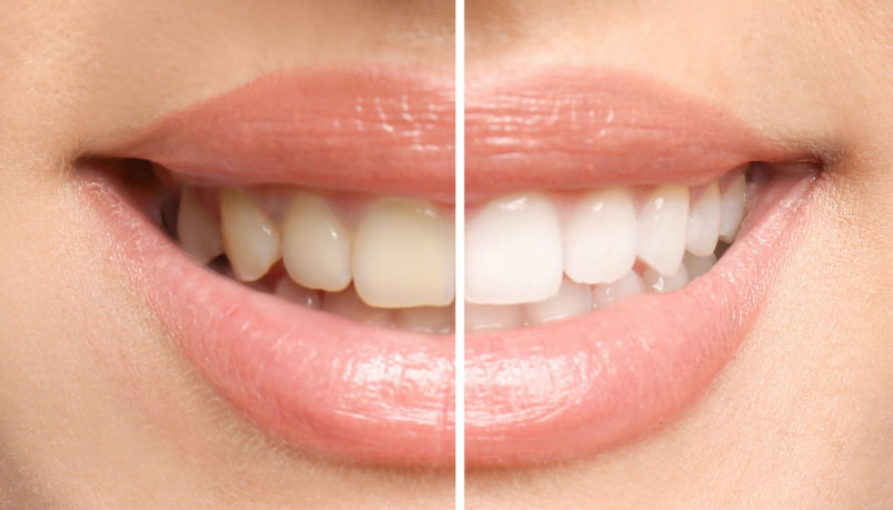 Teeth whitening in Whitby and Ajax